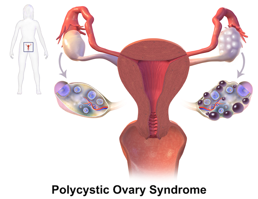 Polycystic ovarian syndrome (PCOS)